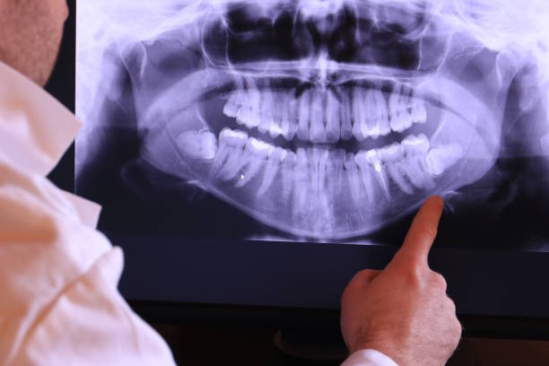 Best Emergency Root Canal Treatment in Bonne Terre, MO