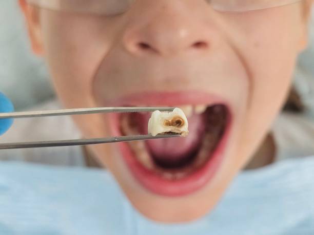 Best Urgent Dental Care for Toothache in Bonne Terre, MO